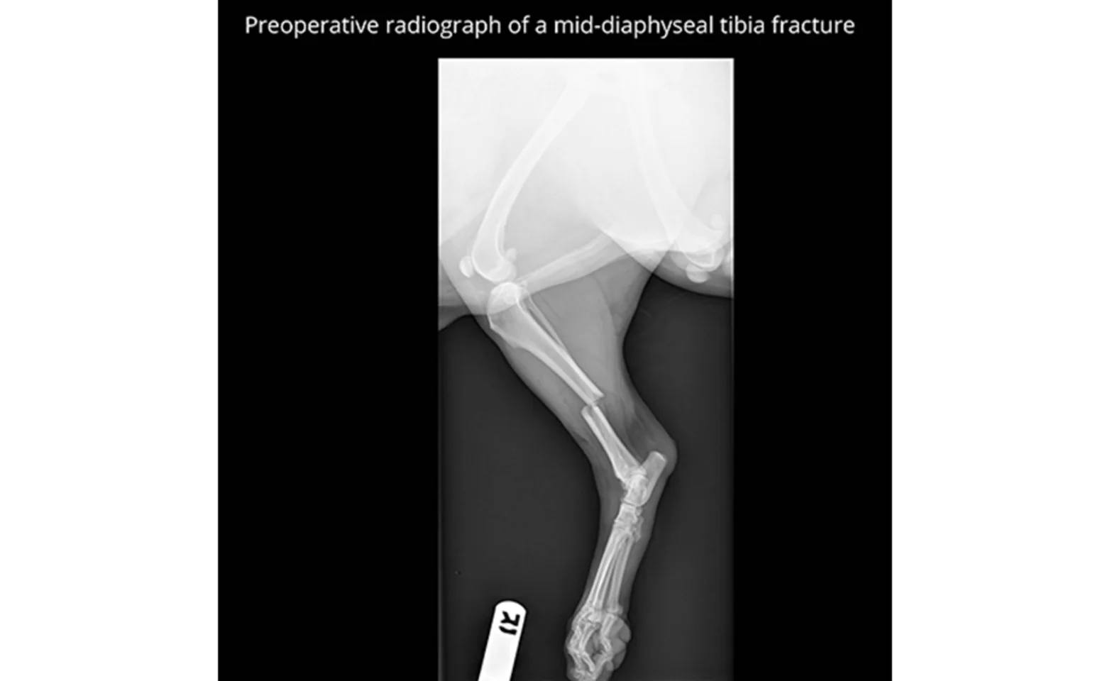 Preoperative Radiograph of a Mid-Diaphyseal Tibia Fracture X-Ray